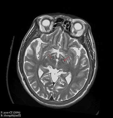 Outcomes of STN-DBS in PD Patients With Different Rates of Disease Progression Over One Year of Follow-Up